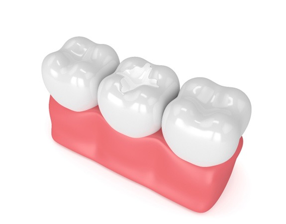 3D render of a dental filling