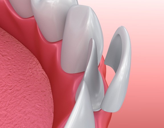 A 3 D illustration of veneers in Marlboro being placed