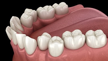 Illustration of crooked teeth