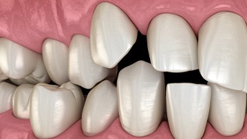 Illustration of spaced-out teeth