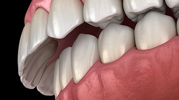 Illustration of overbite