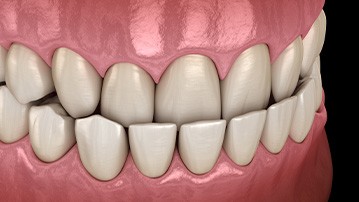 Illustration of an underbite