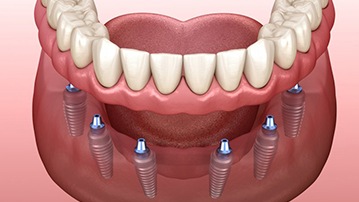 Illustration of implant dentures?